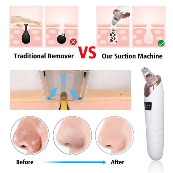 Face Vacuum Suction Blackhead Remover
